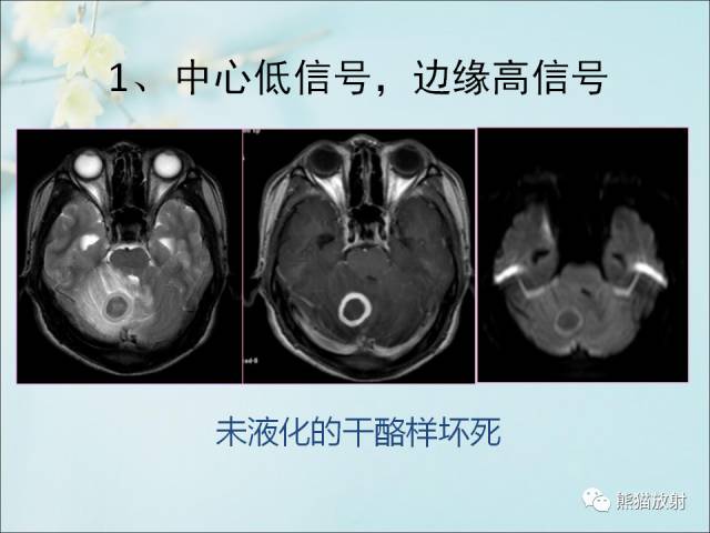 【PPT 】颅内结核专家共识解读