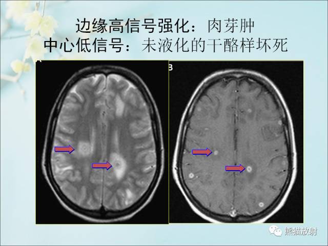 【PPT 】颅内结核专家共识解读