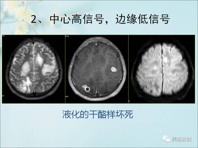 【PPT 】颅内结核专家共识解读