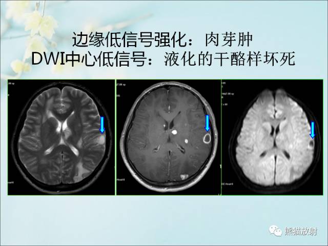 【PPT 】颅内结核专家共识解读