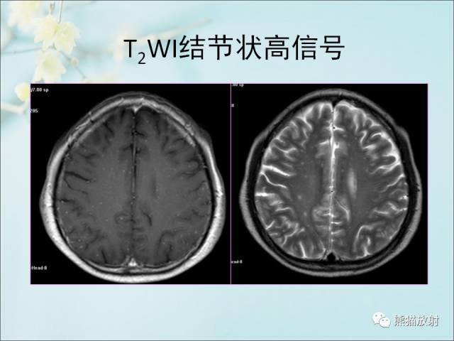 【PPT 】颅内结核专家共识解读
