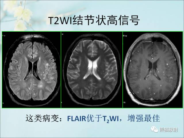 【PPT 】颅内结核专家共识解读