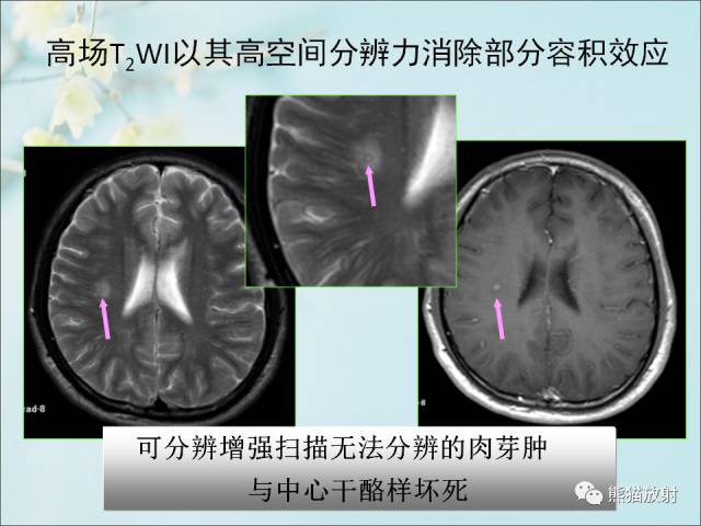 【PPT 】颅内结核专家共识解读