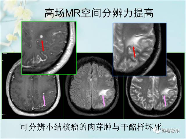 【PPT 】颅内结核专家共识解读