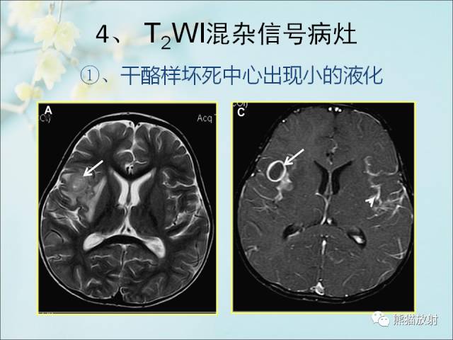 【PPT 】颅内结核专家共识解读