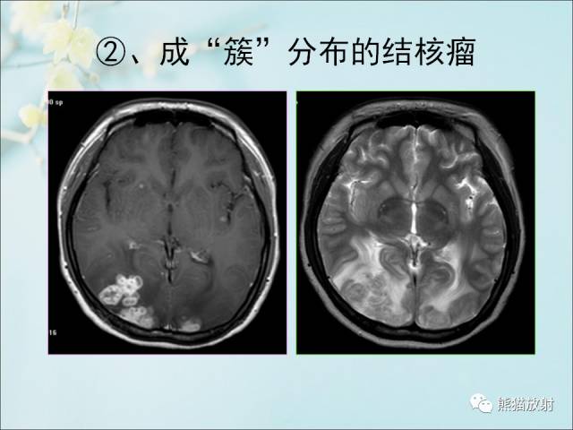 【PPT 】颅内结核专家共识解读