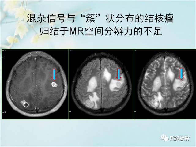 【PPT 】颅内结核专家共识解读