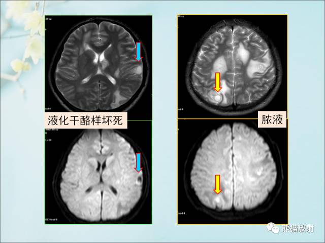 【PPT 】颅内结核专家共识解读