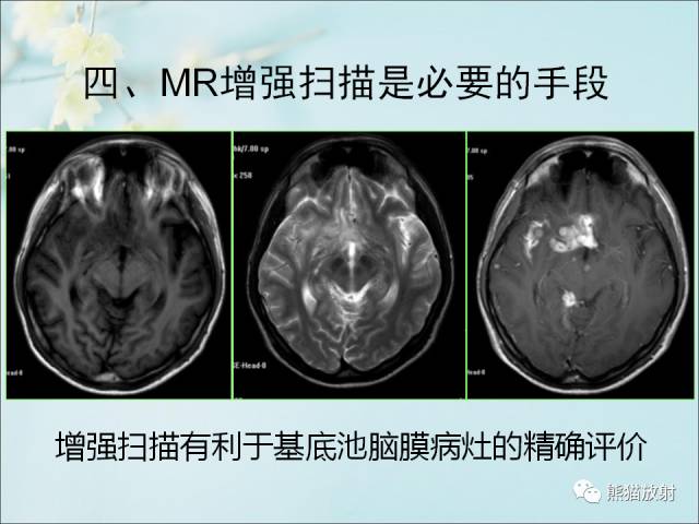 【PPT 】颅内结核专家共识解读