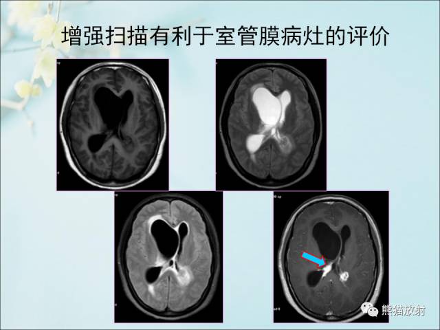 【PPT 】颅内结核专家共识解读