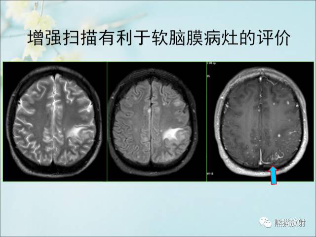 【PPT 】颅内结核专家共识解读