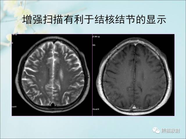 【PPT 】颅内结核专家共识解读