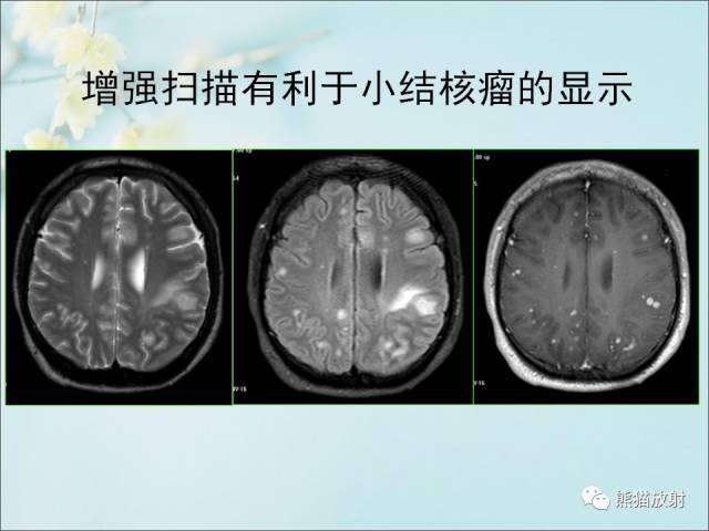 【PPT 】颅内结核专家共识解读