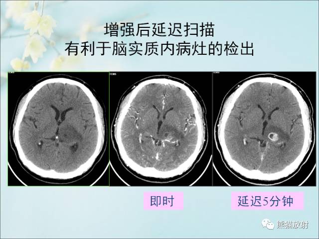 【PPT 】颅内结核专家共识解读