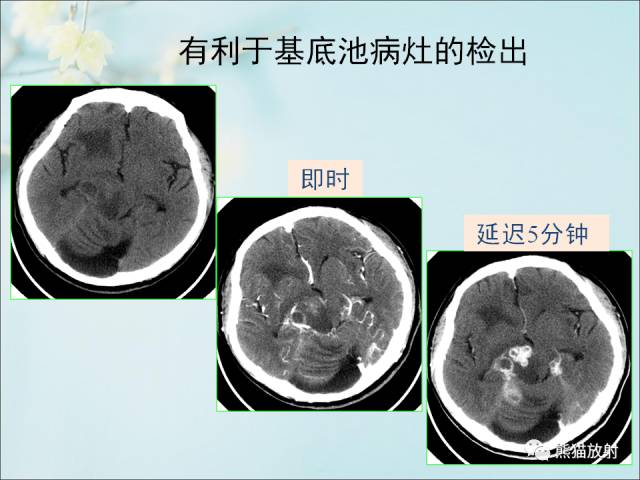 【PPT 】颅内结核专家共识解读
