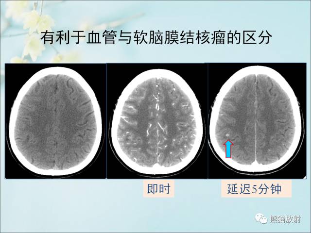 【PPT 】颅内结核专家共识解读