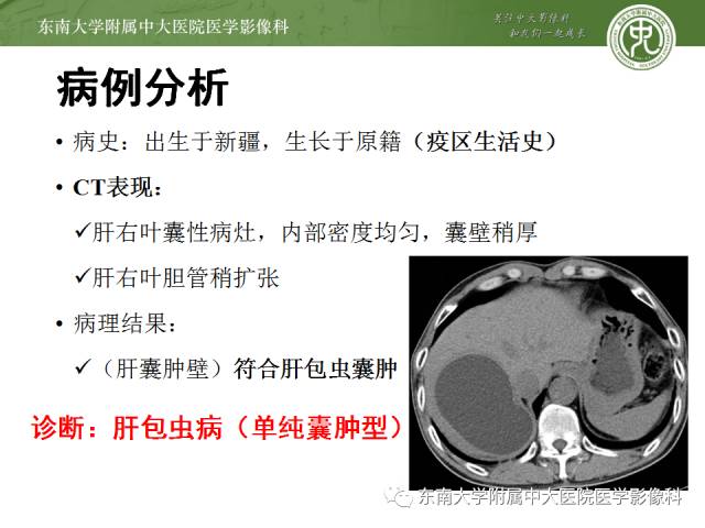 【病例】肝包虫病1例CT影像表现
