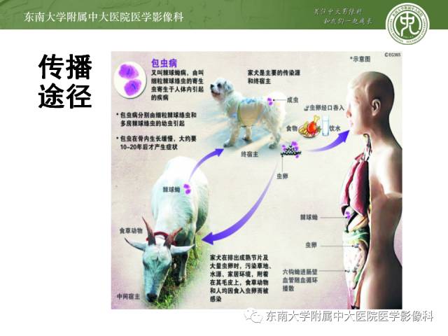 【病例】肝包虫病1例CT影像表现