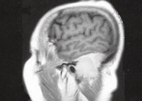 【病例】后颅窝孤立性髓外浆细胞瘤1例MR 【病例】后颅窝孤立性髓外浆细胞瘤1例MR