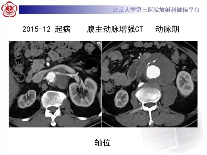 【病例】主动脉腔内修复术后并发症—感染1例CT