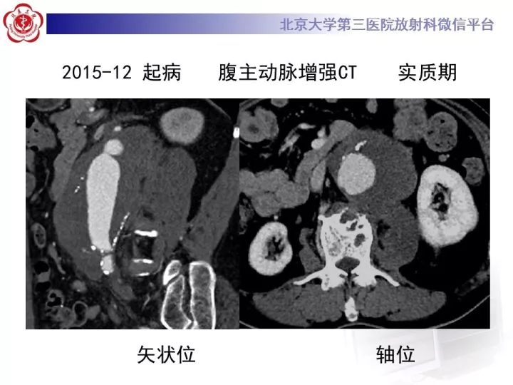 【病例】主动脉腔内修复术后并发症—感染1例CT