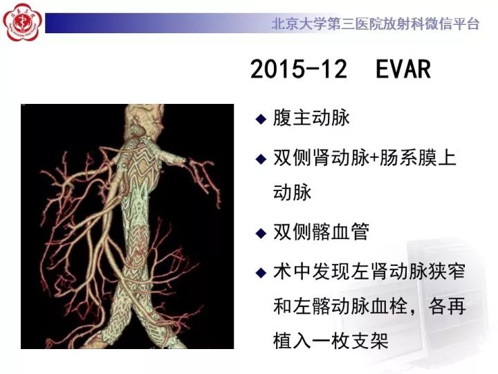 【病例】主动脉腔内修复术后并发症—感染1例CT
