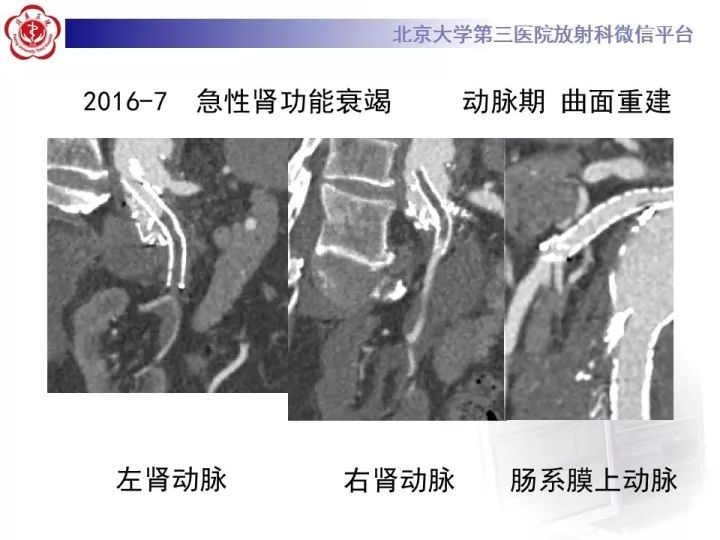 【病例】主动脉腔内修复术后并发症—感染1例CT