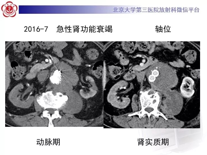 【病例】主动脉腔内修复术后并发症—感染1例CT
