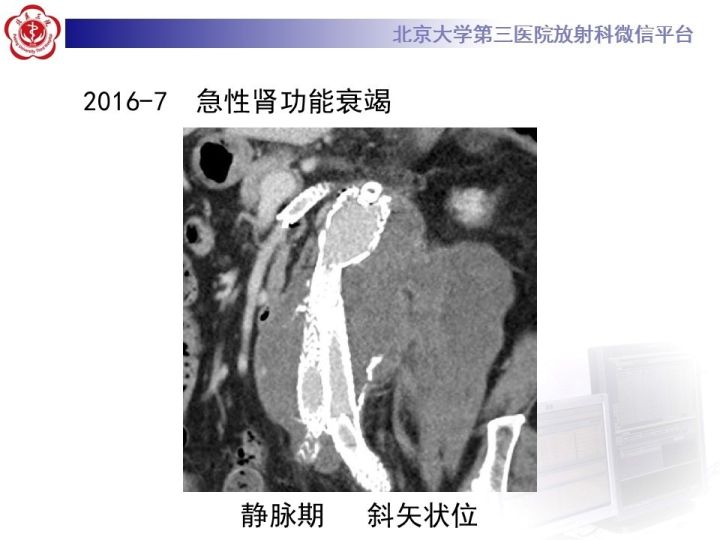 【病例】主动脉腔内修复术后并发症—感染1例CT