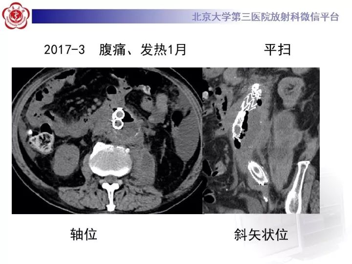 【病例】主动脉腔内修复术后并发症—感染1例CT