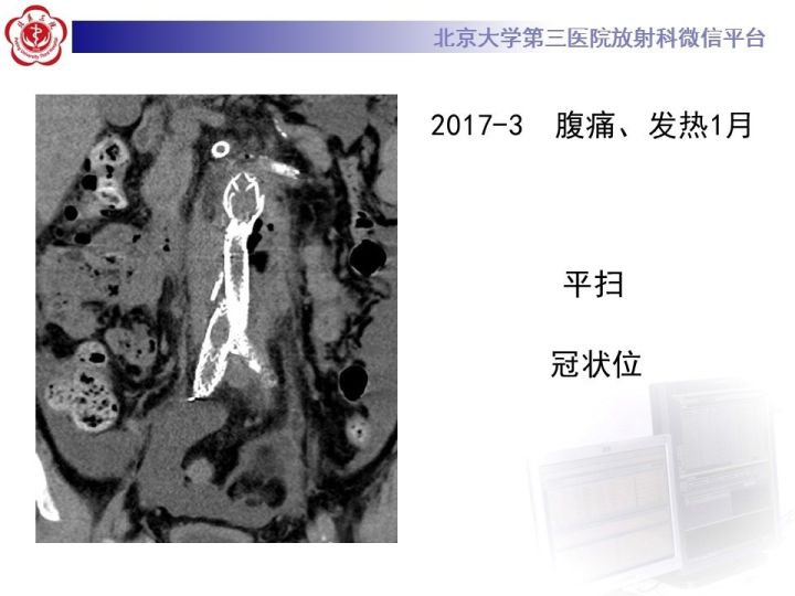 【病例】主动脉腔内修复术后并发症—感染1例CT