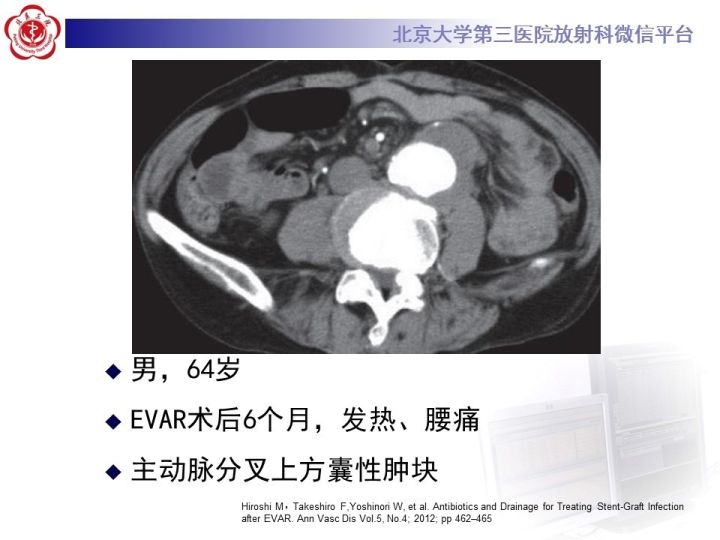 【病例】主动脉腔内修复术后并发症—感染1例CT