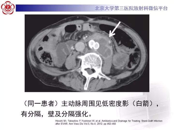 【病例】主动脉腔内修复术后并发症—感染1例CT