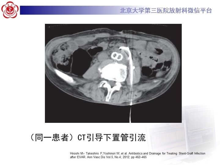 【病例】主动脉腔内修复术后并发症—感染1例CT