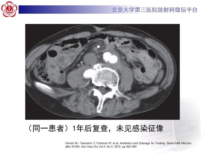 【病例】主动脉腔内修复术后并发症—感染1例CT