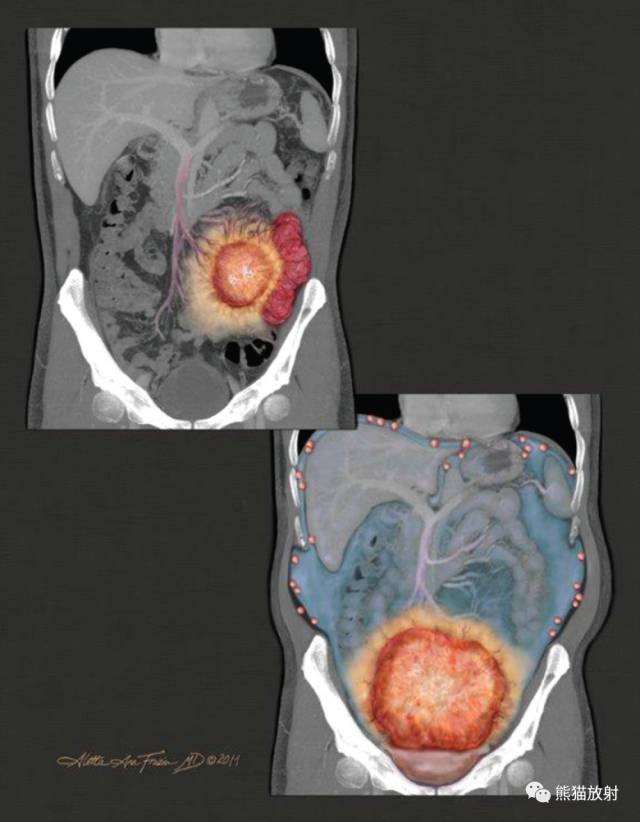 儿童腹腔实性肿瘤 儿童腹腔实性肿瘤