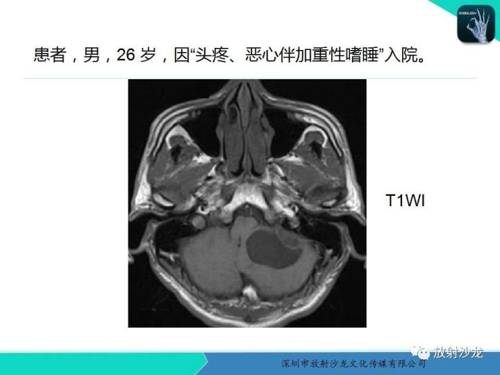 【病例】血管母细胞瘤1例MR