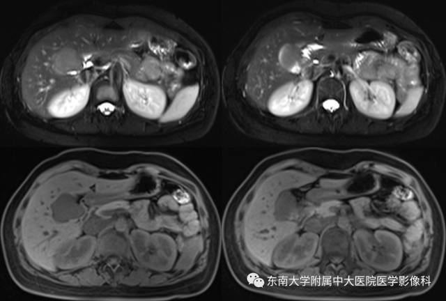 【病例】胆囊平滑肌瘤1例MR