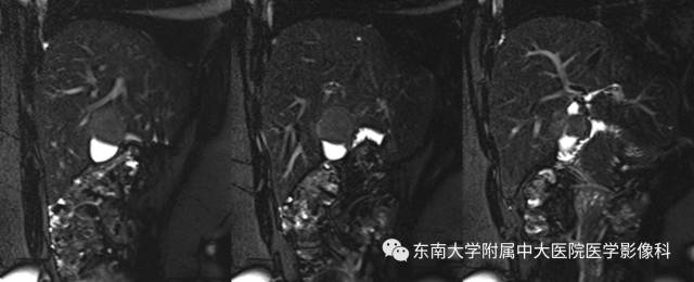 【病例】胆囊平滑肌瘤1例MR