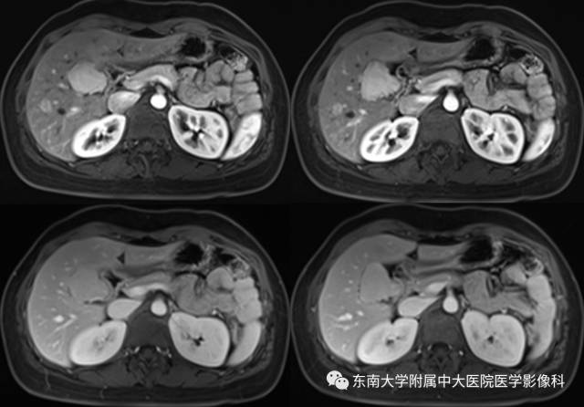 【病例】胆囊平滑肌瘤1例MR