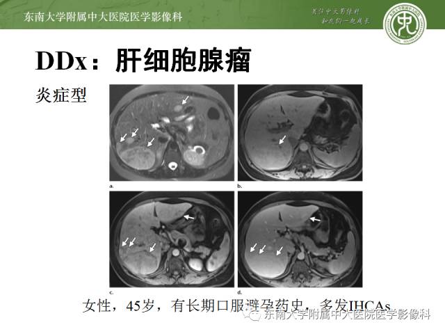 【病例】胆囊平滑肌瘤1例MR