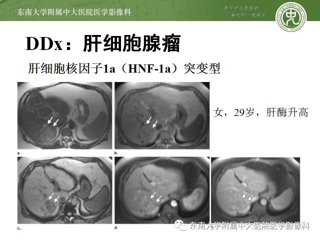 【病例】胆囊平滑肌瘤1例MR