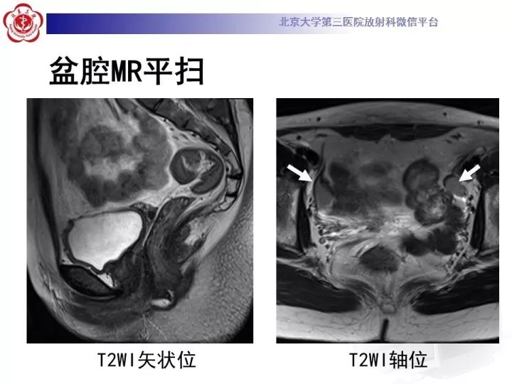 【病例】子宫发育畸形2例MR