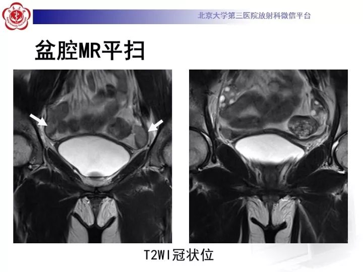 【病例】子宫发育畸形2例MR