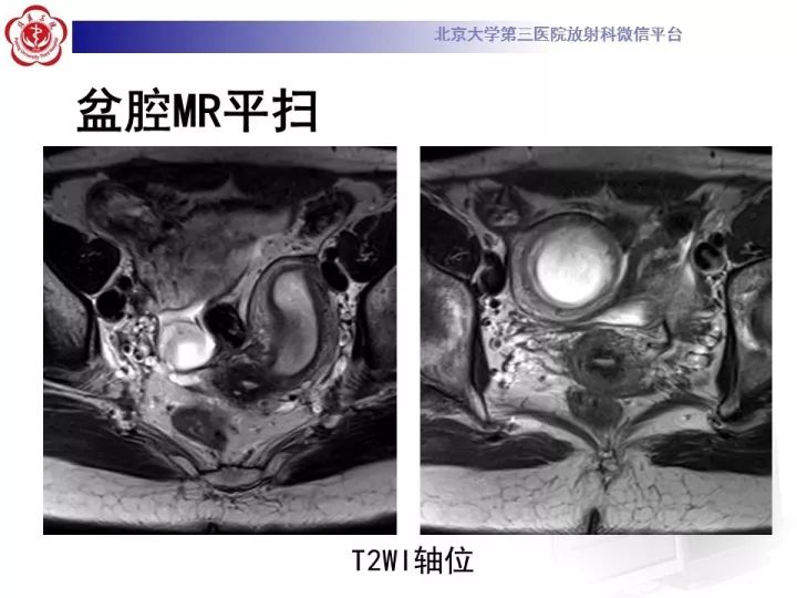 【病例】子宫发育畸形2例MR