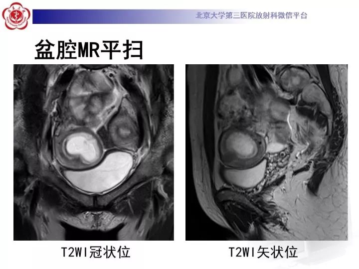 【病例】子宫发育畸形2例MR