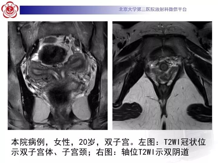 【病例】子宫发育畸形2例MR