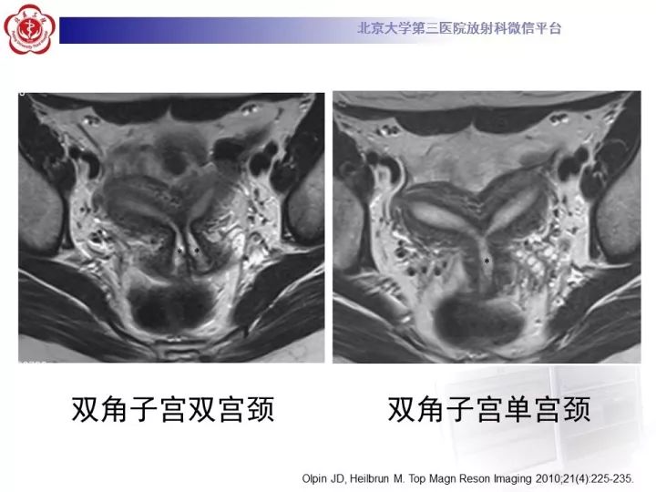 【病例】子宫发育畸形2例MR