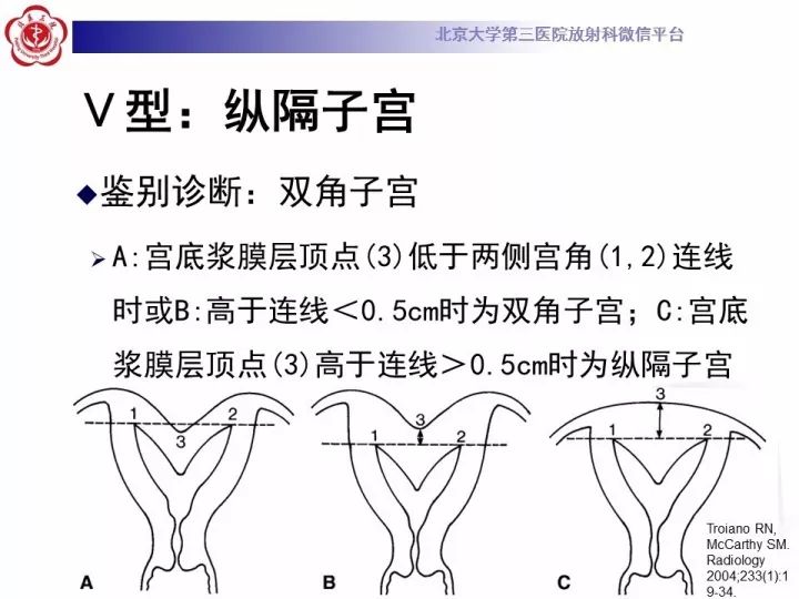 【病例】子宫发育畸形2例MR