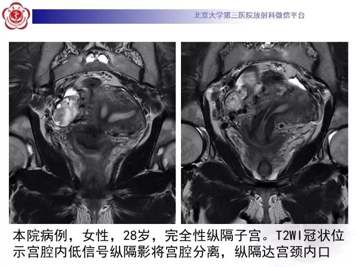 【病例】子宫发育畸形2例MR